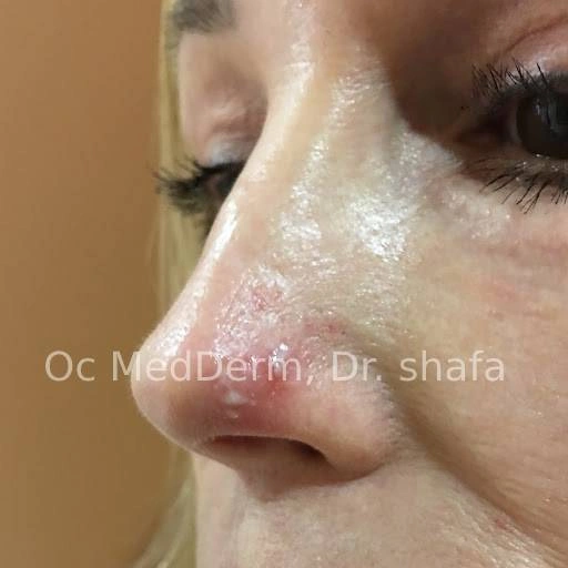 Nose Shingles Infection on women