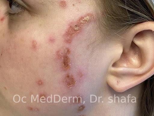 Shingles Infection after three weeks