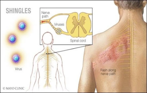 Shingles Overview