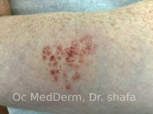 Shingles blisters drying out