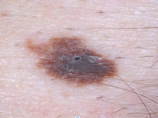 atypical mole