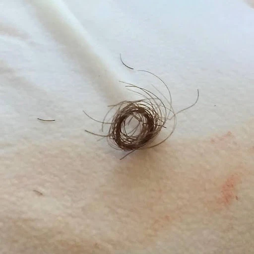 Ingrown Hair Removal at OC Medderm Serving Orange County