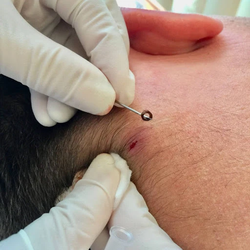 Ingrown Hair Removal Treatment at OC MedDerm In Irvine CA