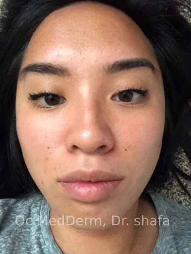 After-BTX-for-TMJ-Jaw-contouring-OC-MedDerm