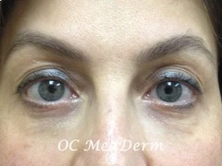 After Botox Treatment Irvine CA at OC MedDerm