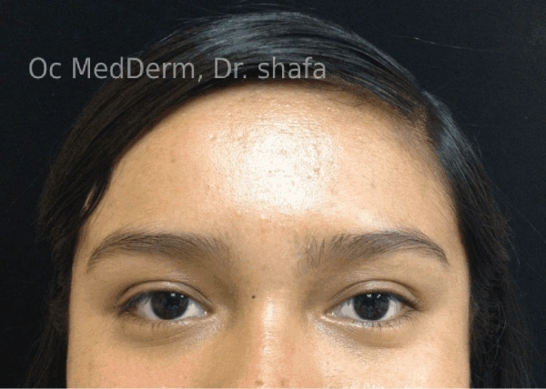 After Mole Excision Irvine, CA at OC MedDerm