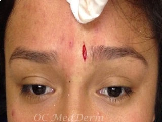 After Mole Excision Irvine CA