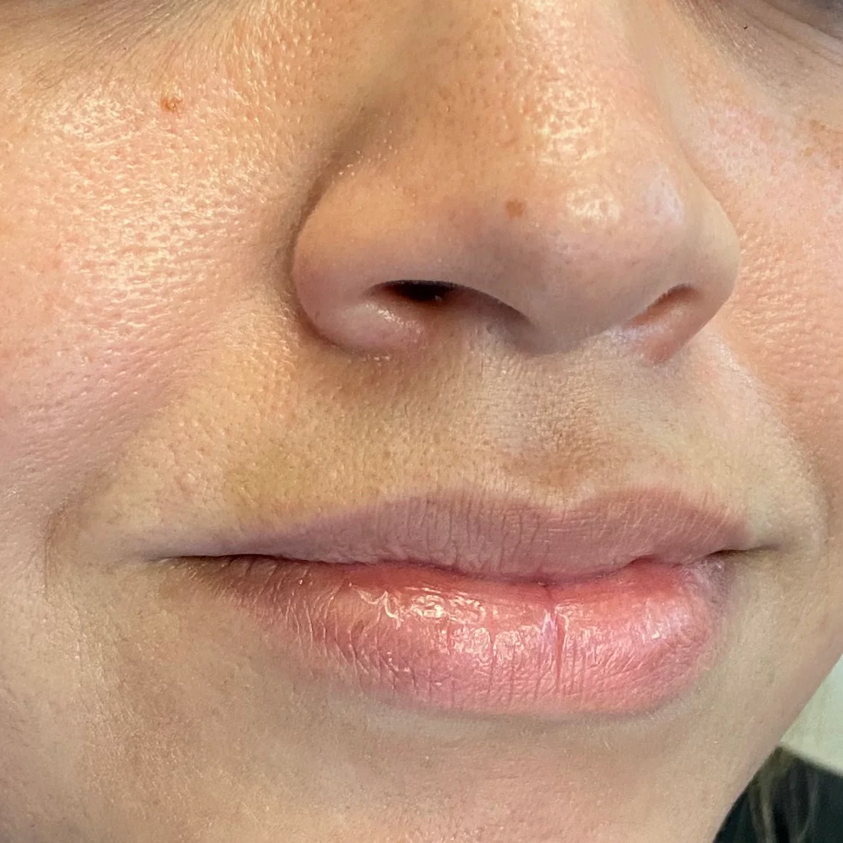 After image showing smooth skin near the upper lip following facial mole removal at OC MedDerm in Orange County