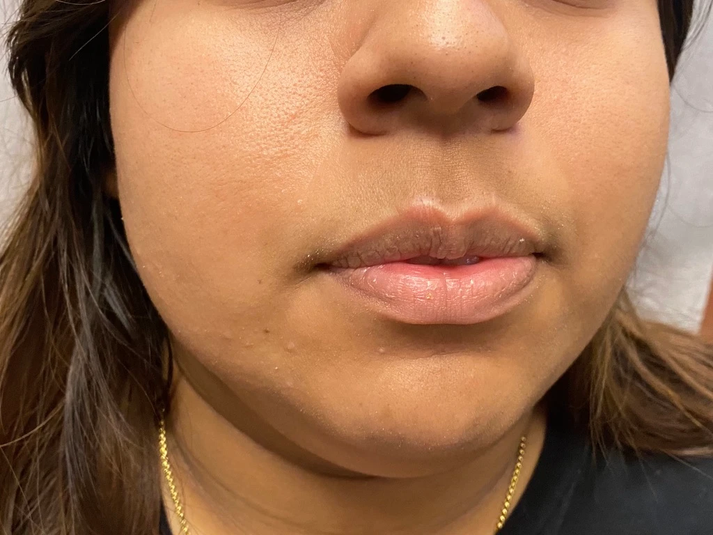 After Mole removal Treatment In Irvine, CA at OC MedDerm