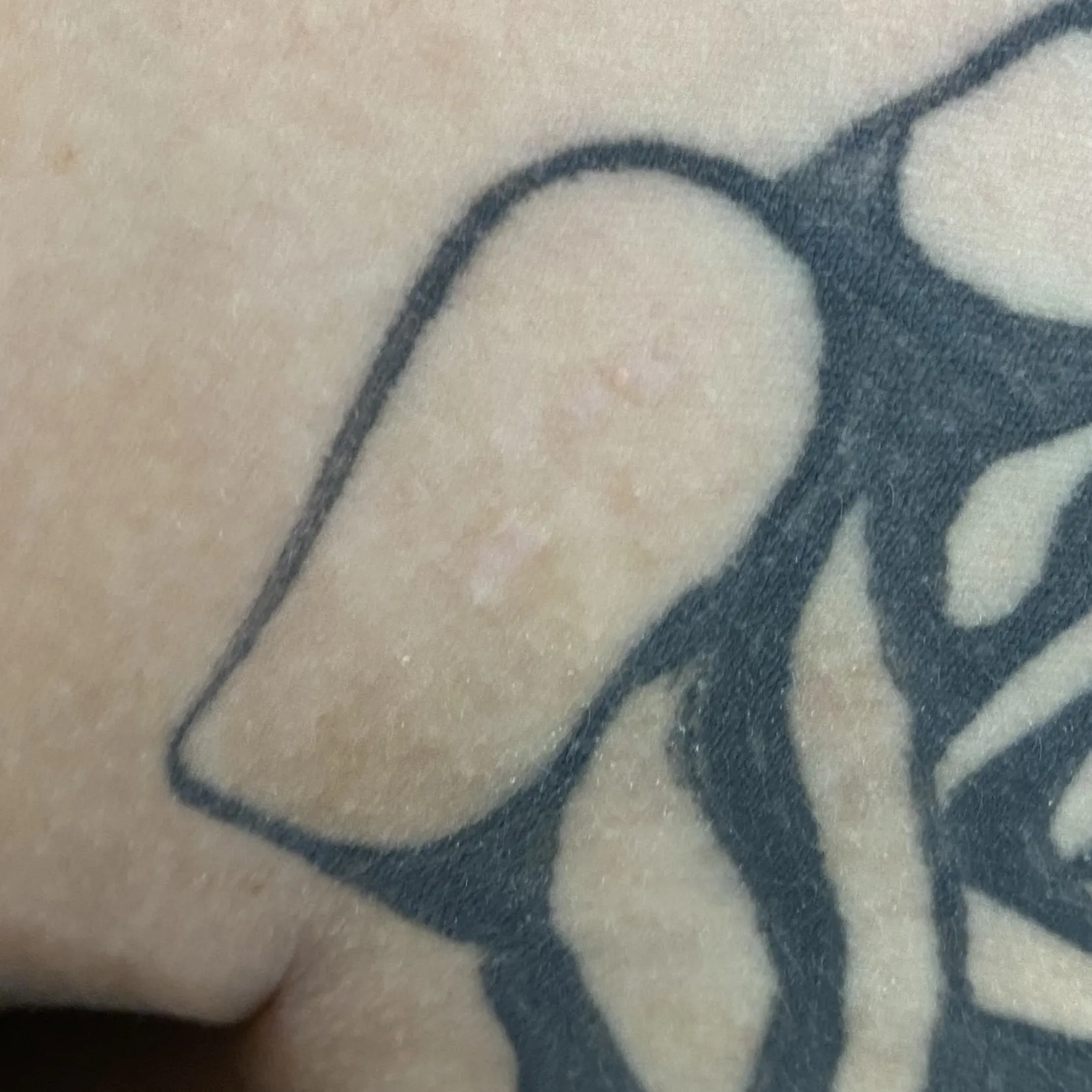 After image showing healed skin on tattooed area following skin lesion removal at OC MedDerm Dermatology in Orange County