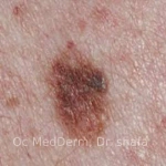 Atypical Mole - between benign and cancer Irvine, CA at OC MedDerm