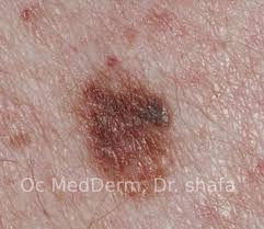 Atypical mole (dysplastic nevus) Irvine, CA at OC medDerm