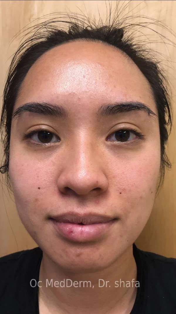 BTX-for-TMJ-Jaw-contouring-OC-MedDerm
