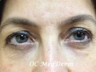 Before Botox Treatment Irvine CA