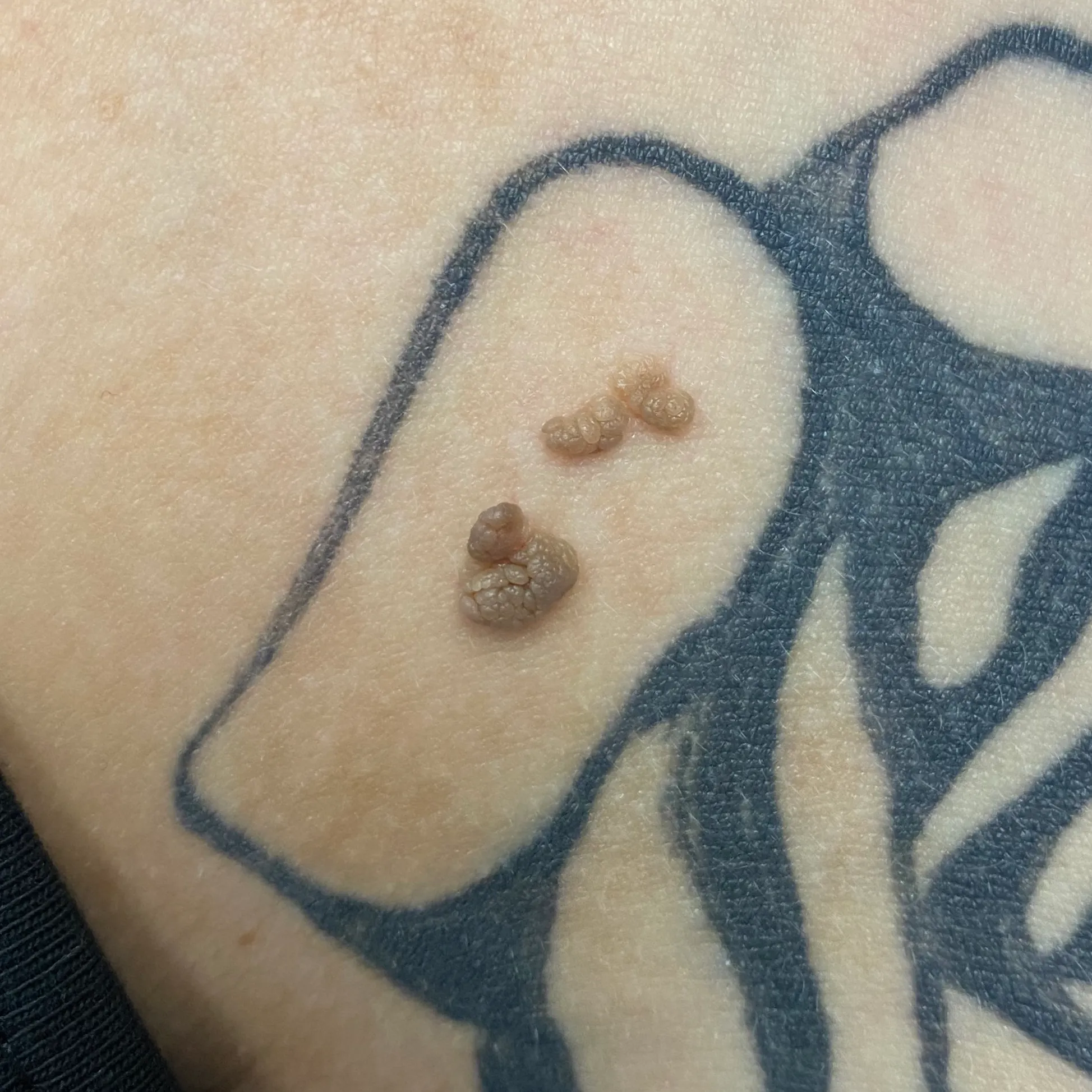 Before image showing multiple raised benign skin lesions on tattooed skin prior to dermatologic removal at OC MedDerm in Irvine, California