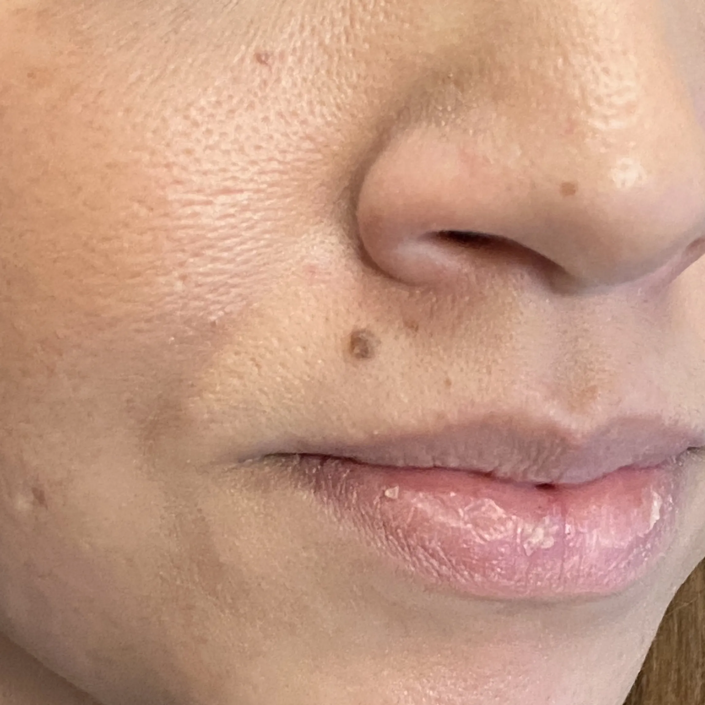 Before image showing a facial mole near the upper lip prior to dermatologic treatment at OC MedDerm in Irvine, California
