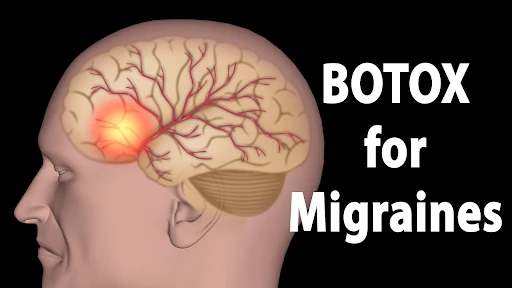 Botox for Migrains Irvine CA at OC MedDerm
