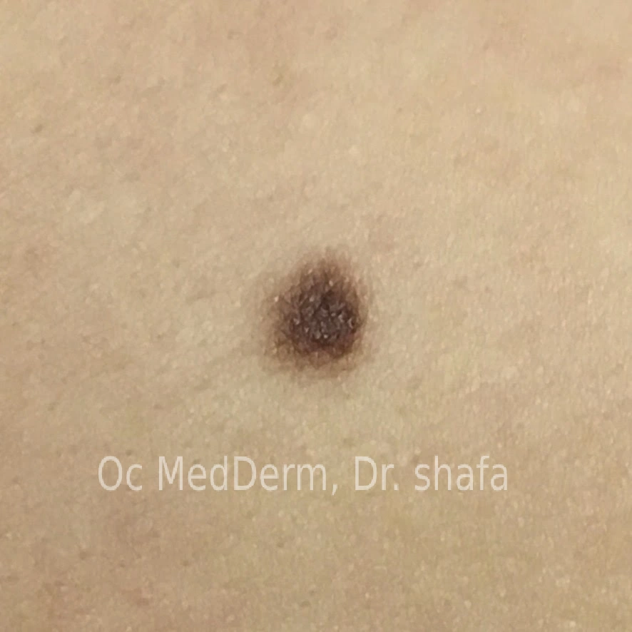 Compound nevi Irvine CA at OC MedDerm