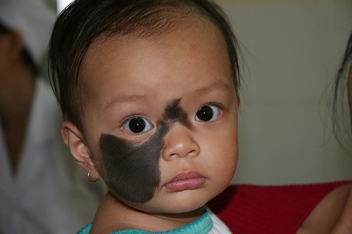 Congenital Mole at baby's Face irvine CA
