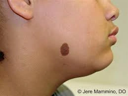 Congenital Mole at bottom of cheek Irvine CA