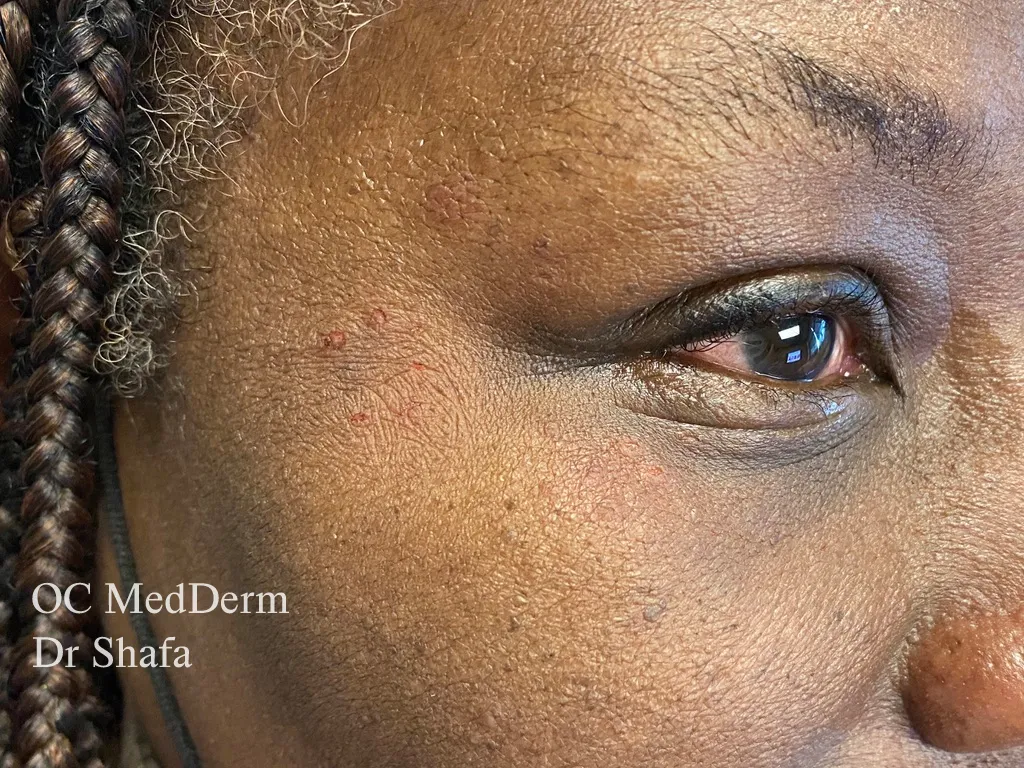 DPN After Eyelid Bumps Surgery at OCMedDerm
