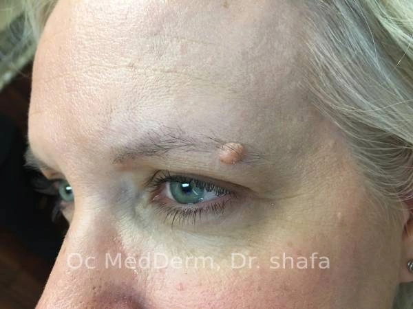 Dermal nevi at Eyebrow - Irvine, CA