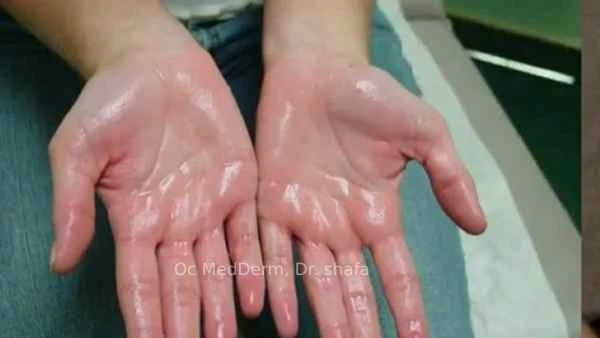 Excessive sweating in hands Irvine CA at OC MedDerm