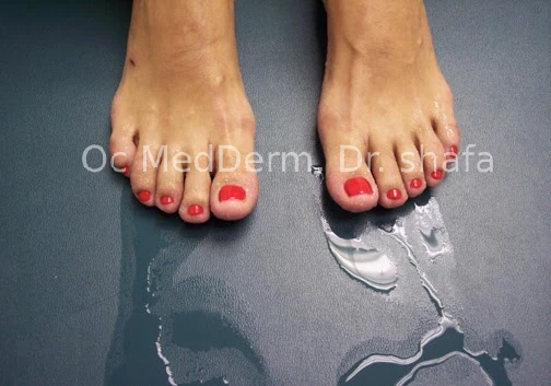 Excessive sweating in legs Irvine, CA