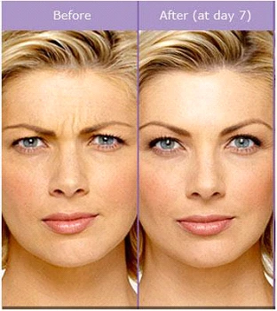 Forehead lines Before and After Treatment irvine CA at OC MedDerm