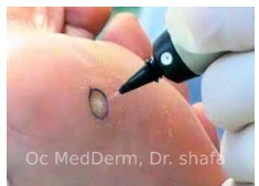 Laser Mole removal OC MedDerm