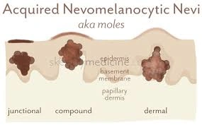 Junctional, Compound, Intradermal Moles Irvine CA at OC MedDerm