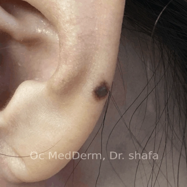 Junctional Nevi Irvine CA