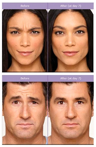 Male and Female of Before and After Botox Treatment Irvine CA