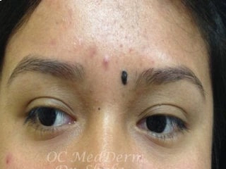 Mole Excision Irvine, CA at OC MedDerm