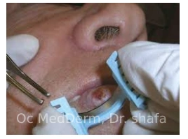 Mole Shaving Irvine CA at OC MedDerm