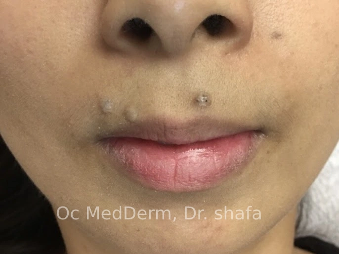 Natural Mole Removal Irvine, CA
