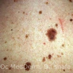 Unusual, Atypical-looking mole Irvine CA OC MedDerm