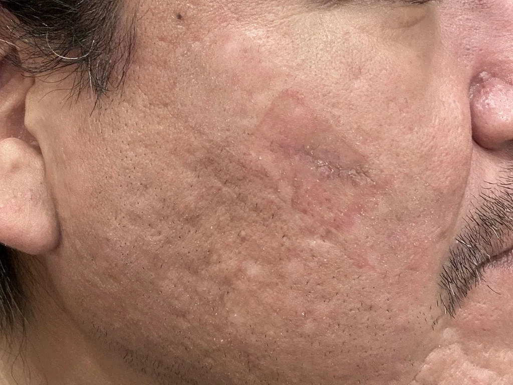 Acne scar corrected by Excision in Irvine, CA