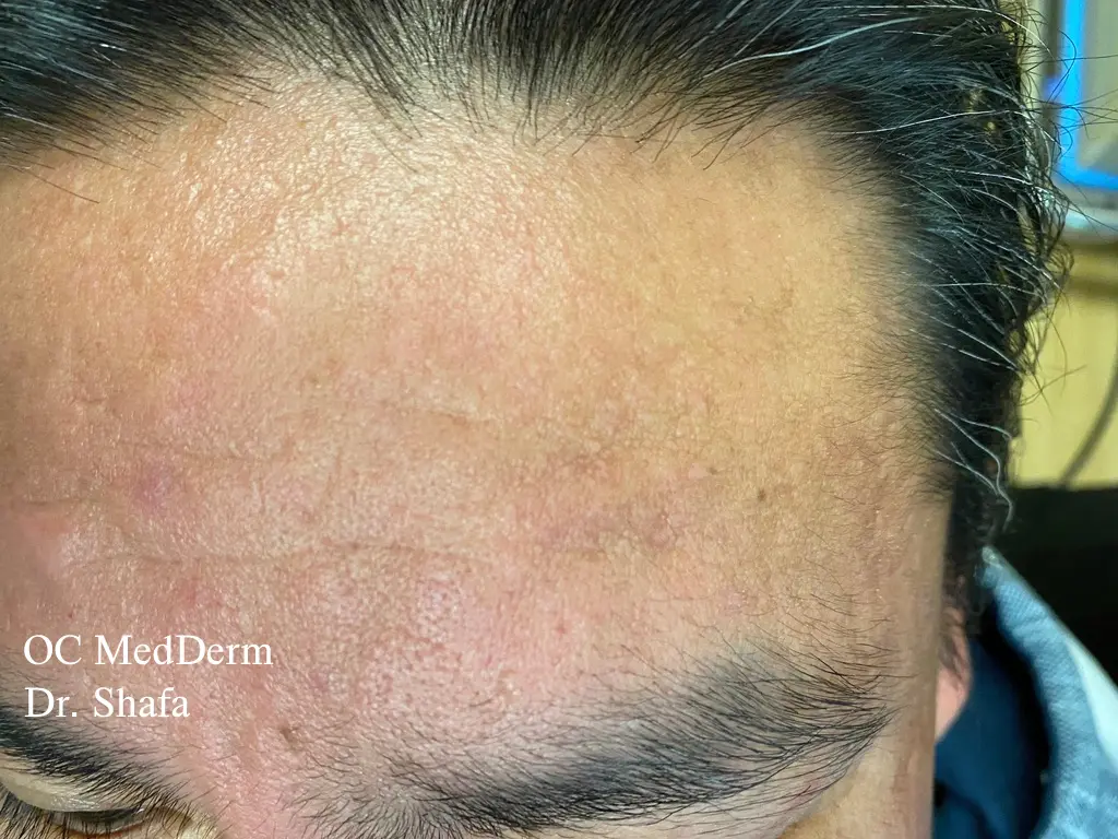 After Acne scar removal by steroid injection Irvine, CA at OC MedDerm