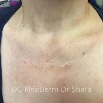 After Keloid Treatment with Steroid Injection in Irvine, CA
