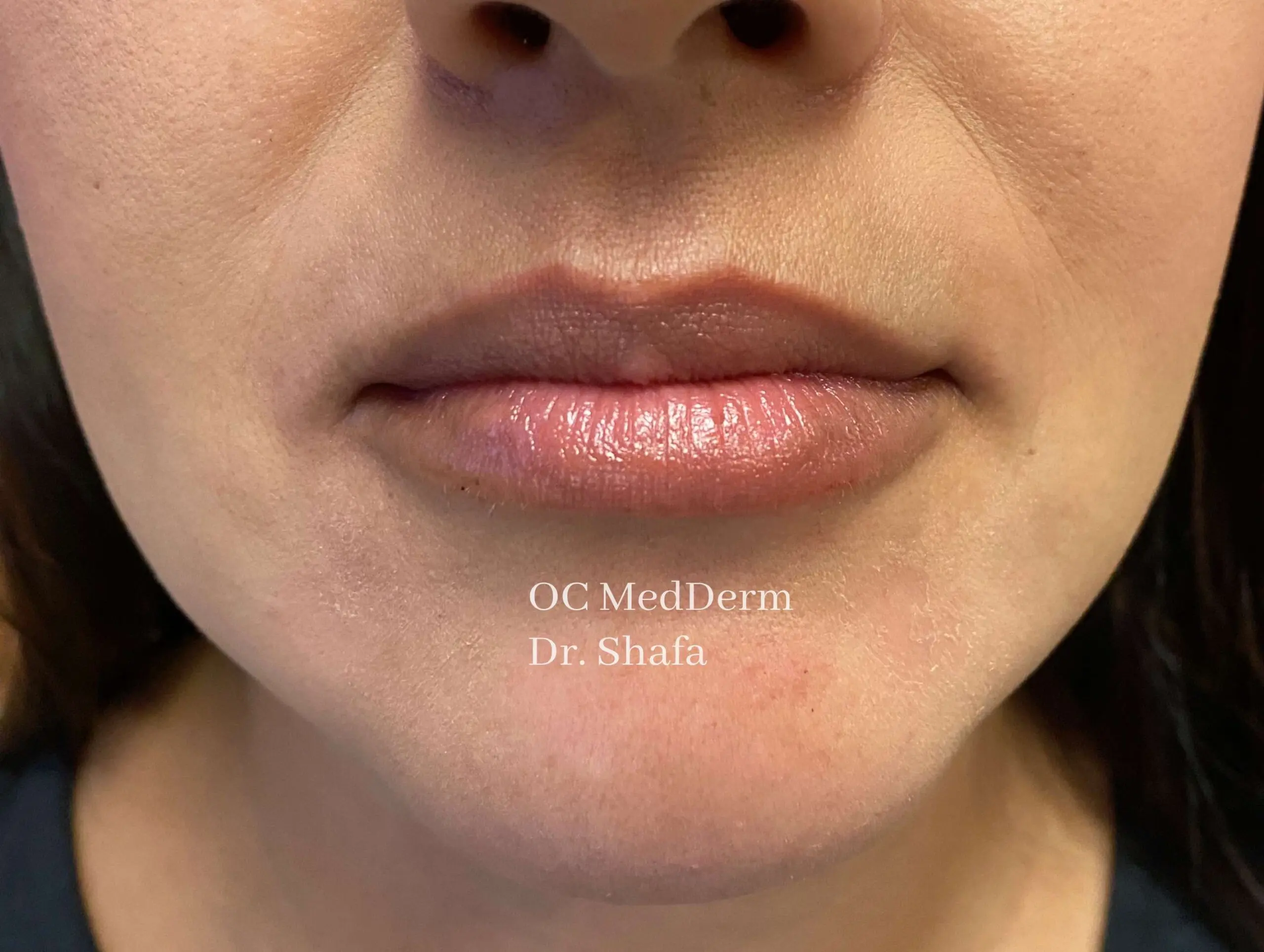 After Lip Asymmetry Correction with Fillers in Irvine, CA at OC MedDerm
