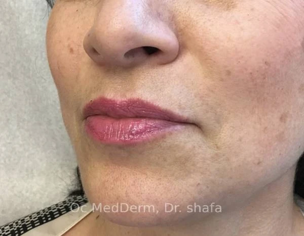 After Mole Removal Treament on Upperlip in Irvine, CA