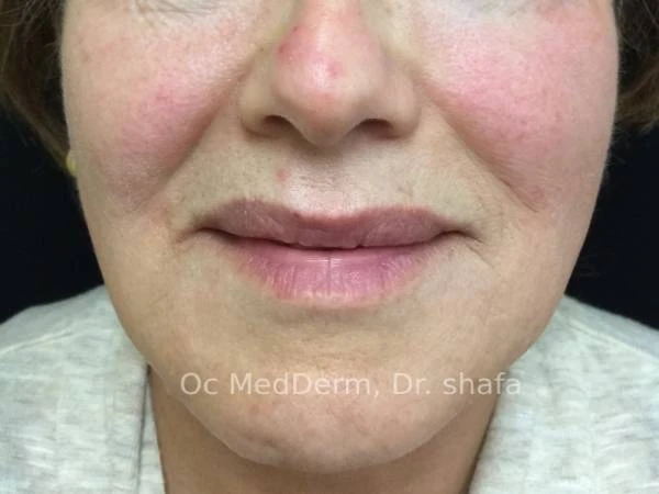 After Mole Removal Treatment on Cheek in Irvine, CA