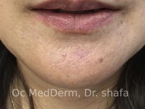 After Mole Removal Treatment on Chin in Irvine, CA