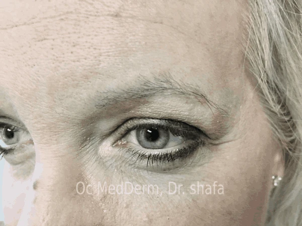 After Mole Removal Treatment on Eyebrow in Irvine, CA