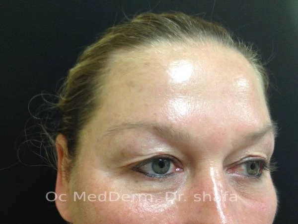 After Mole Removal Treatment on Forehead in Irvine, CA