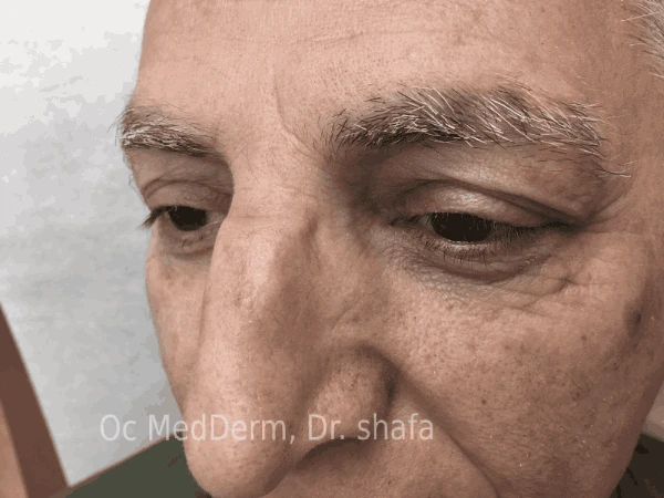 After Mole Removal Treatment on Nose at OC MedDerm