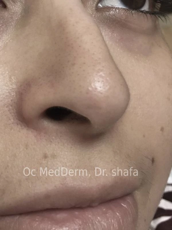 After Mole Removal Treatment under Nose in Irvine, CA