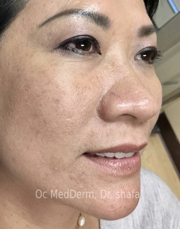 After Mole Removal on Cheek at OC MedDerm