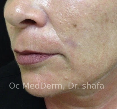 After Mole Removal on Cheek in Irvine, CA